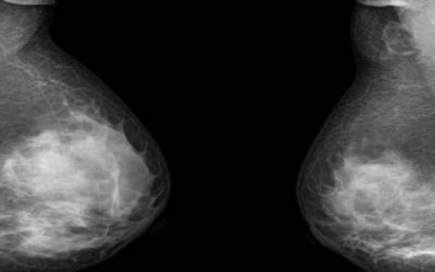 Diagnosing breast cancer